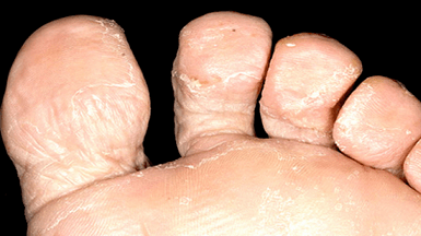 how to recognize the presence of a fungus between the toes