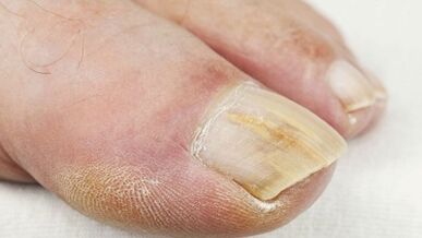 The initial stage of the development of the fungus on the nails
