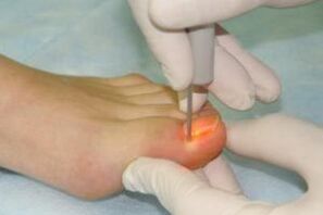 mechanical removal of the nail for fungal infection
