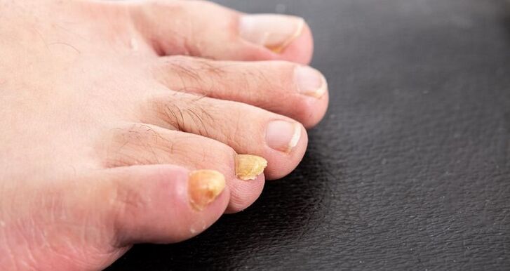 yellowing of nails due to foot fungus