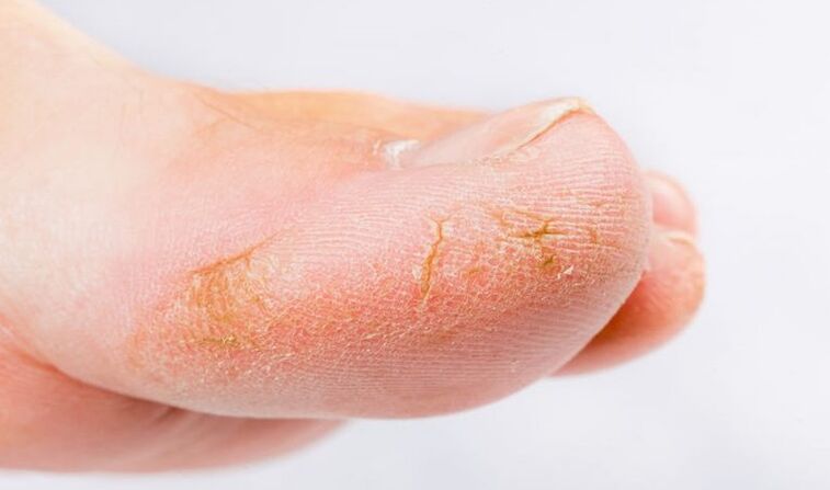 symptoms of skin fungus on feet