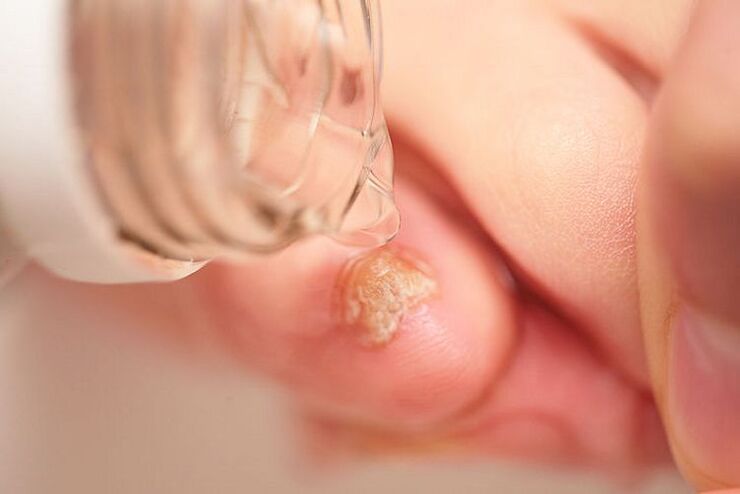 How does hydrogen peroxide act on fungus
