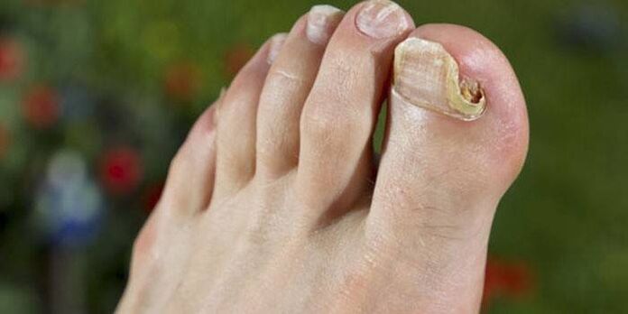 fungus on the big toe nail