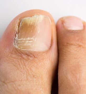Fungus of the nail on the big toe, which occurs against the background of weak immunity