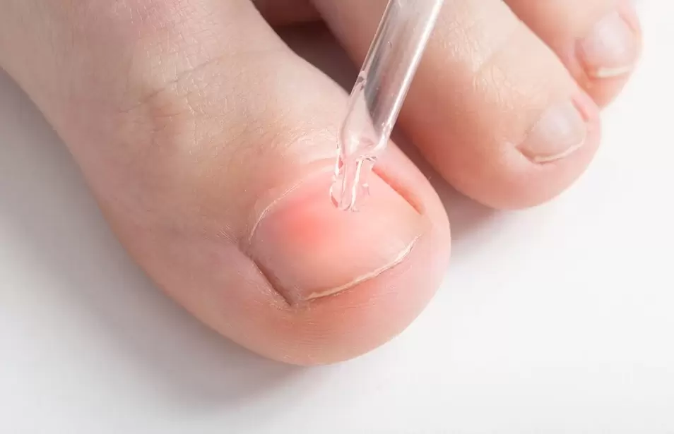 Treatment of onychomycosis with an antifungal solution