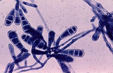 bacteria causing nail fungus